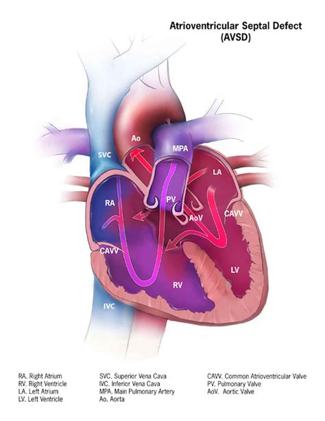 what is avsd heart defect