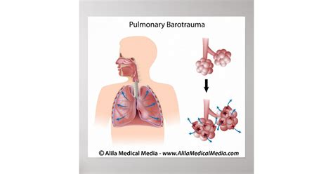 What Is Barotrauma Mechanical Ventilation