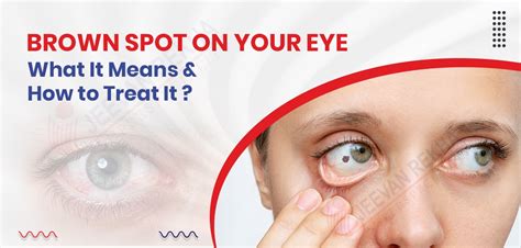 what is black spots in vision