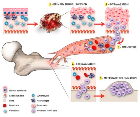 what is bony metastases