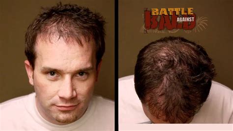 Bosley Hair Transplant Results Fashion Hairstyle