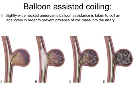 What Is Brain Coiling