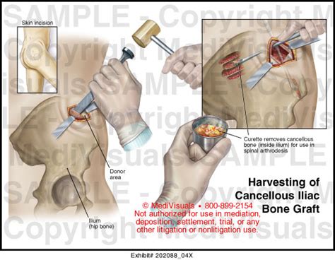 what is cancellous bone graft