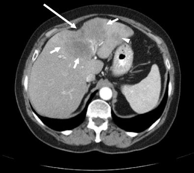 What Is Capsular Retraction