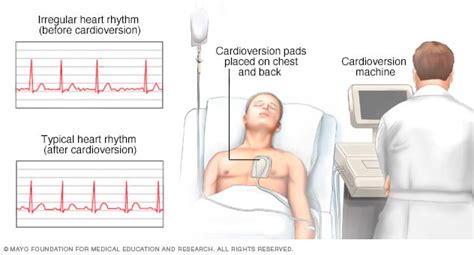 Understanding Heart Rhythm Restoration: What is Cardioversion and When is it Used?