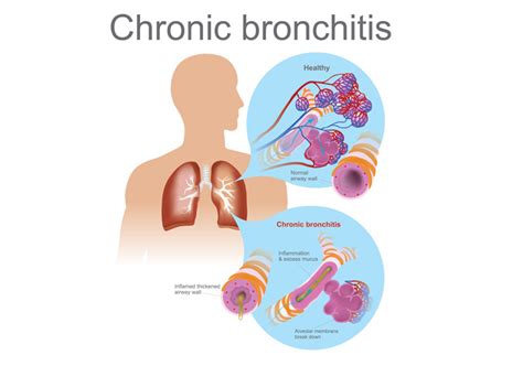 Understanding What is Chronic Bronchitis and Its Long-Term Effects