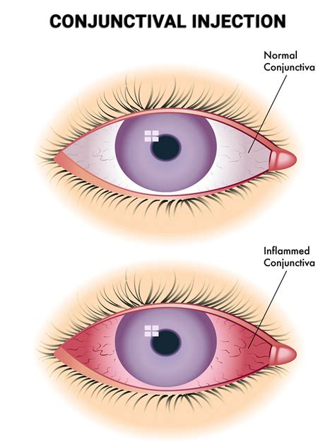 what is conjunctival injection