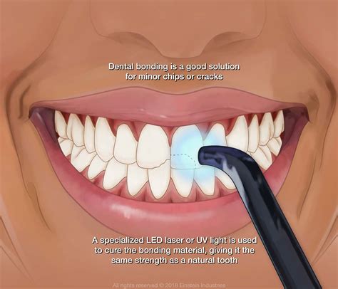 what is cosmetic bonding for teeth