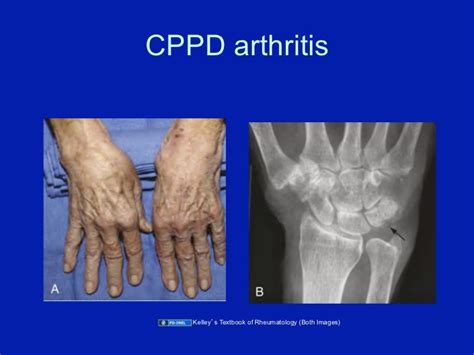 what is cppd arthritis