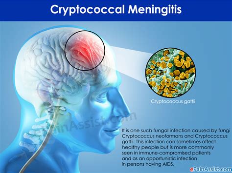what is cryptococcal meningitis