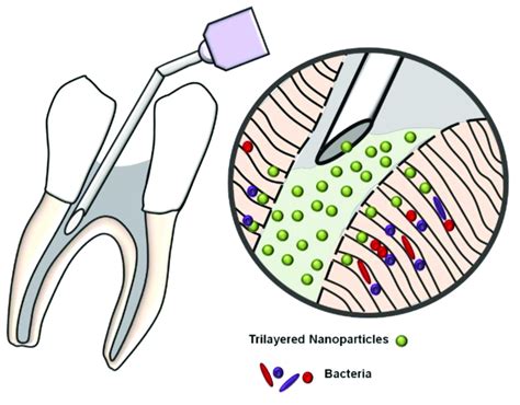 What Is Dentinal Map Endodontics
