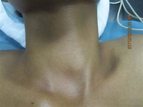 What Is Diffuse Enlargement Of The Thyroid