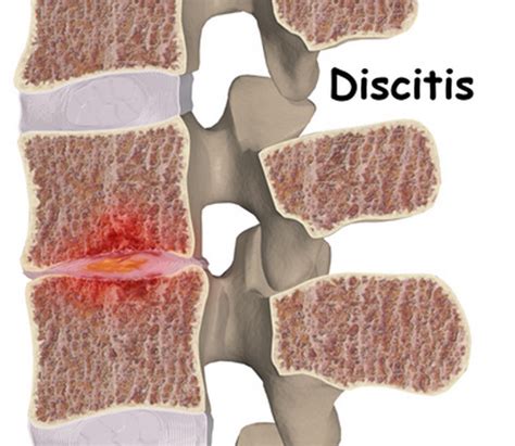 what is discitis in the back