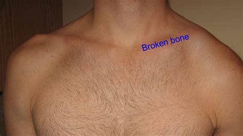what is done for a broken collarbone