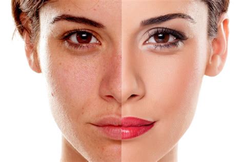 what is dull complexion