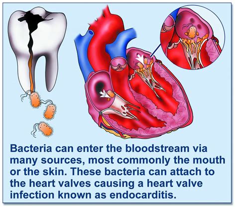 Understanding Endocarditis: A Rare but Serious Heart Infection