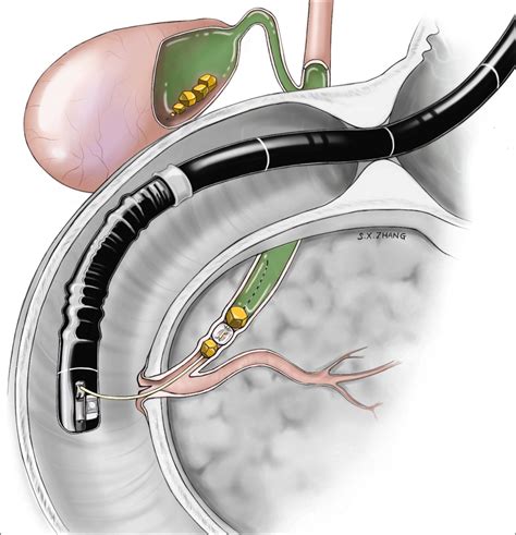 what is endoscopic retrograde cholangiopancreatography