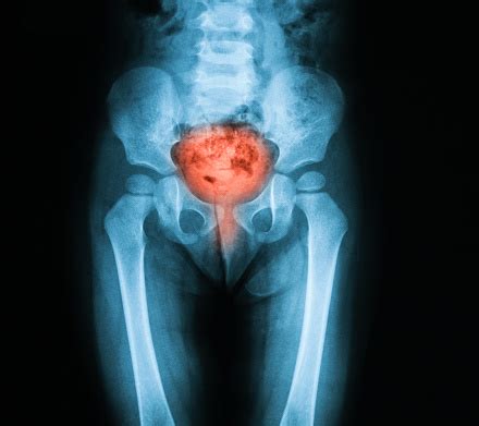 What Is Enlarged Bladder
