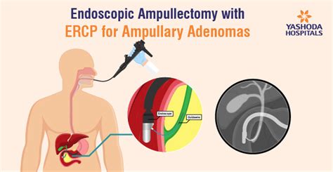 What Is Ercp With Ampullectomy