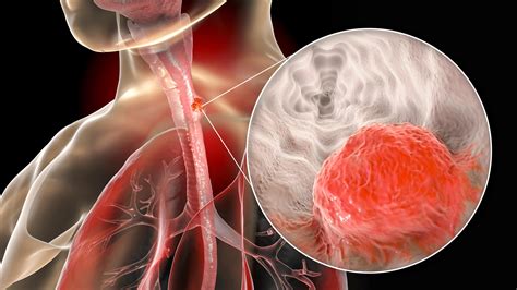 what is esophageal adenocarcinoma