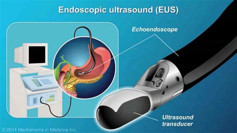 What Is Eus Endoscopy