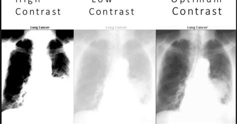 What Is Film Density In Radiography