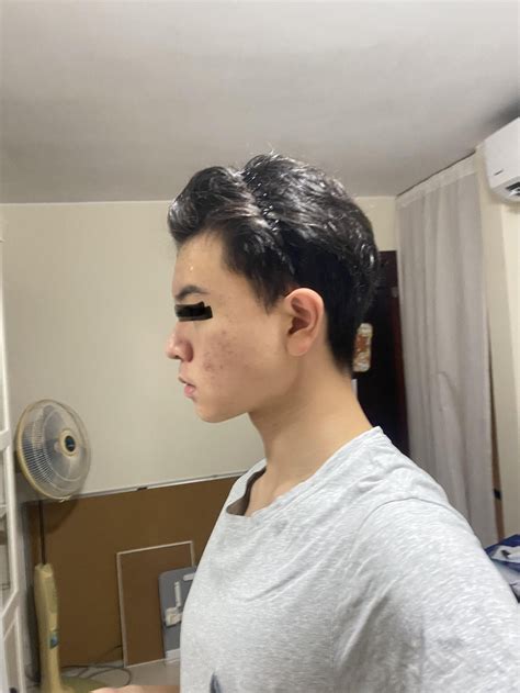 what is flat maxilla