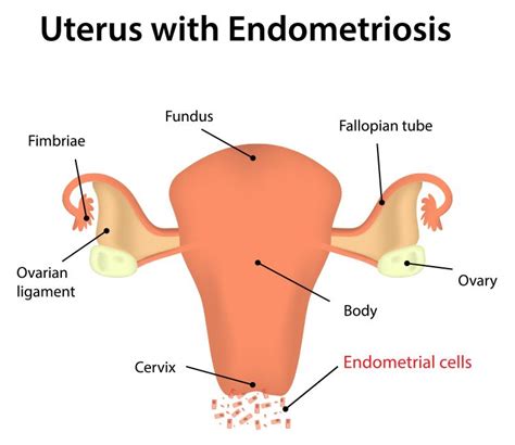 what is fulguration of endometriosis