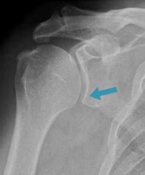 what is glenoid dysplasia