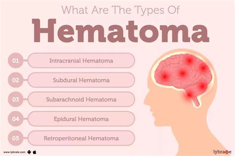 Understanding Hematoma: Causes, Symptoms, and Effective Treatment Options