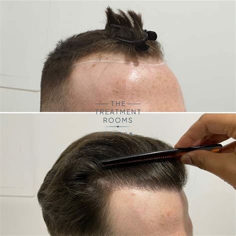  79 Popular What Is High Density Hair Transplant For Short Hair