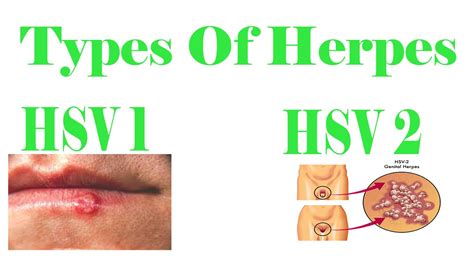 what is hsv type 1 and 2