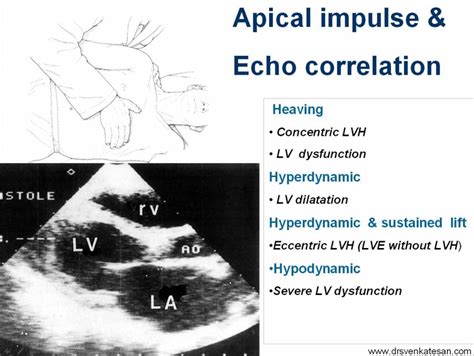 what is hyperdynamic apical impulse