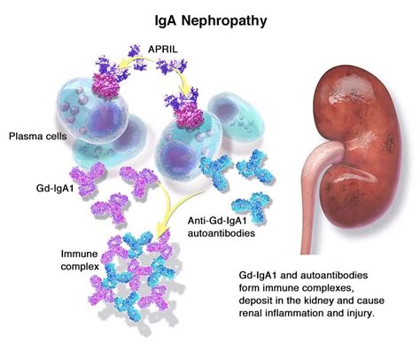 what is iga nephropathy kidney disease
