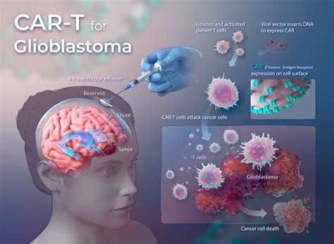 what is immunotherapy for glioblastoma