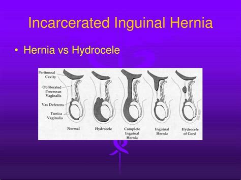 what is incarcerated inguinal hernia