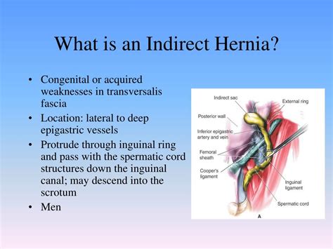 what is indirect hernia