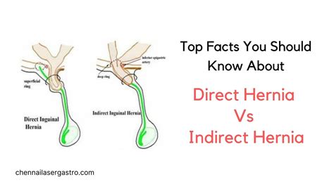 what is indirect inguinal hernia