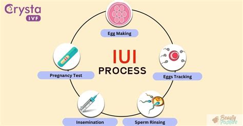 what is iui treatment for pregnancy