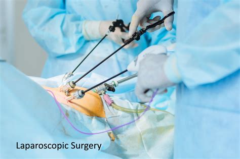 Understanding What is Laparoscopic Surgery and Its Benefits