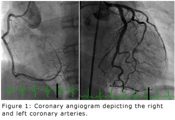 what is lhc in cardiology