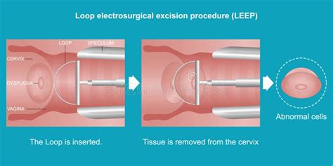 What Is Loop Electrosurgical Excision