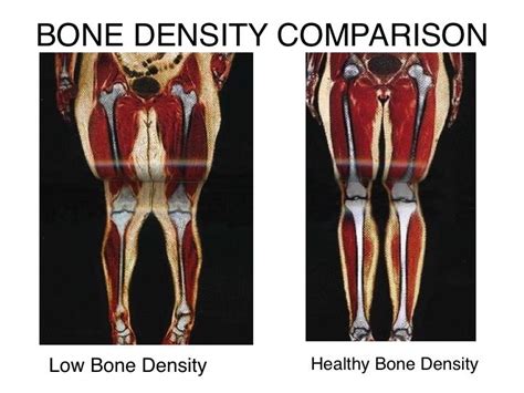 What Is Low Bone Density Mean