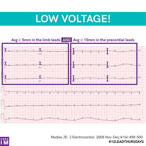what is low voltage qrs on ekg