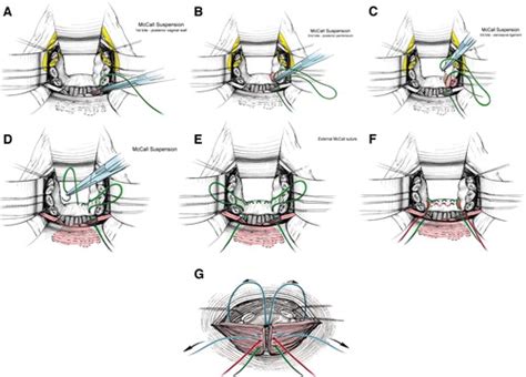 what is mccall culdoplasty