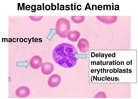 what is megaloblastic anemia and its causes