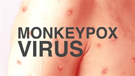 what is monkeypox virus