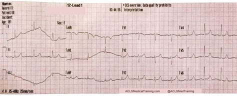 what is motion artifacts in ecg