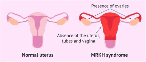 Understanding MRKH: Mayer-Rokitansky-Küster-Hauser Syndrome Explained