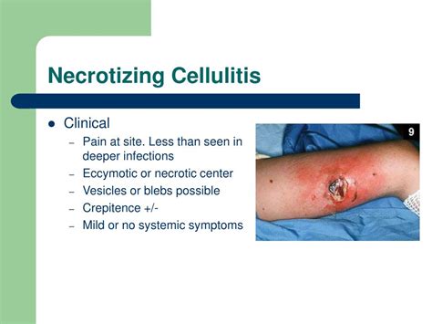 what is necrotizing cellulitis